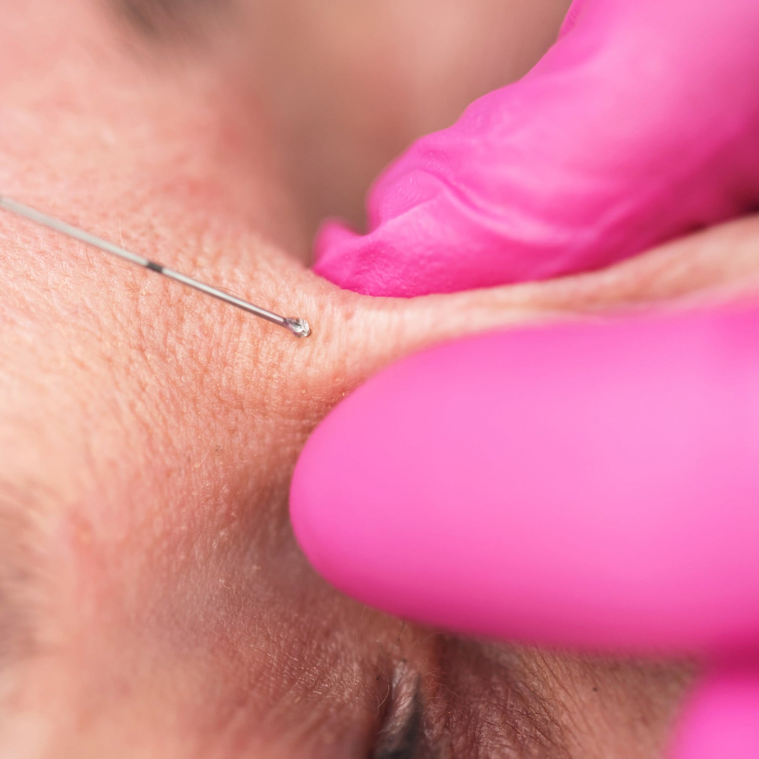 woman having her cheek pinched and receiving botox injection