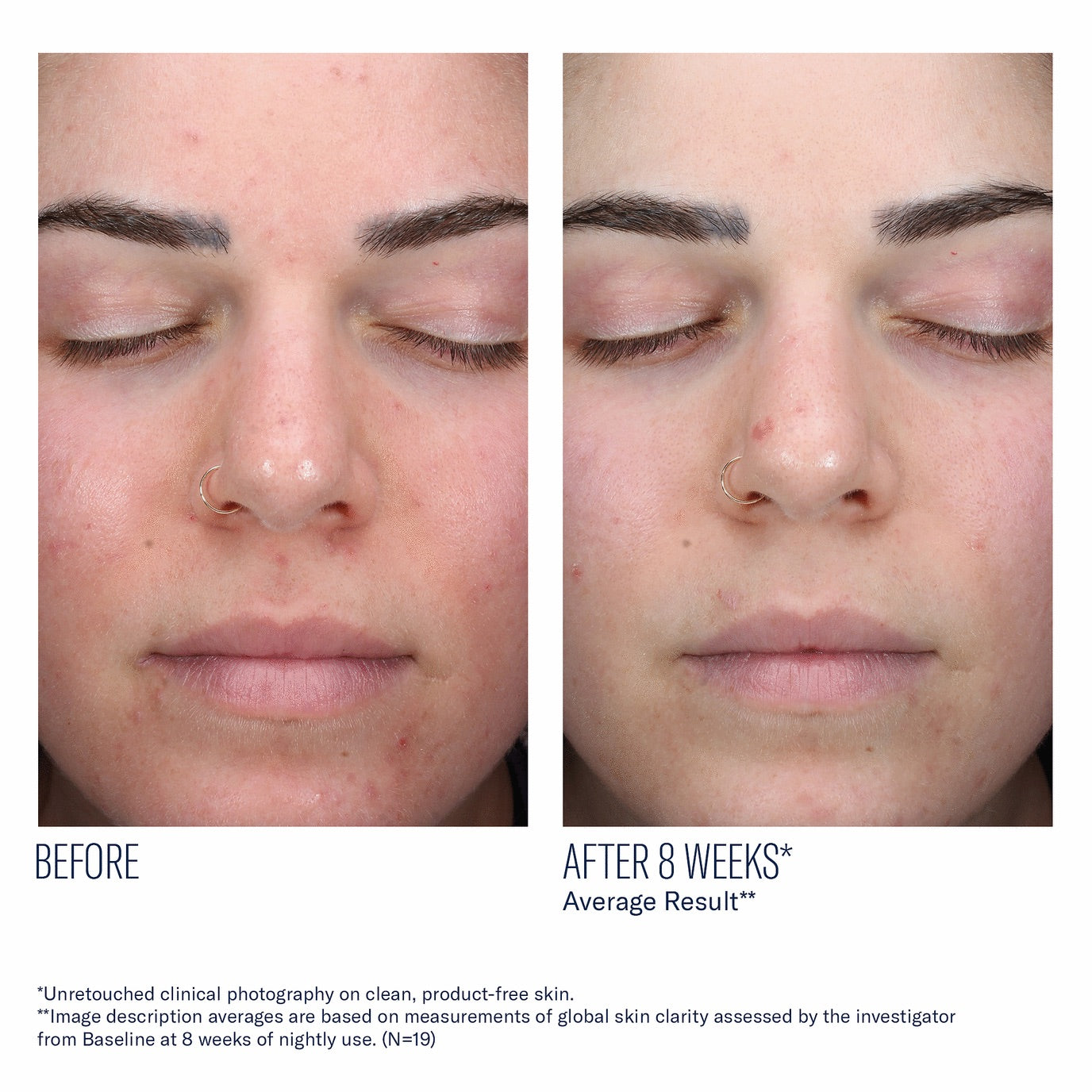 AlphaRet Clearing Serum - Skinbetter Science
