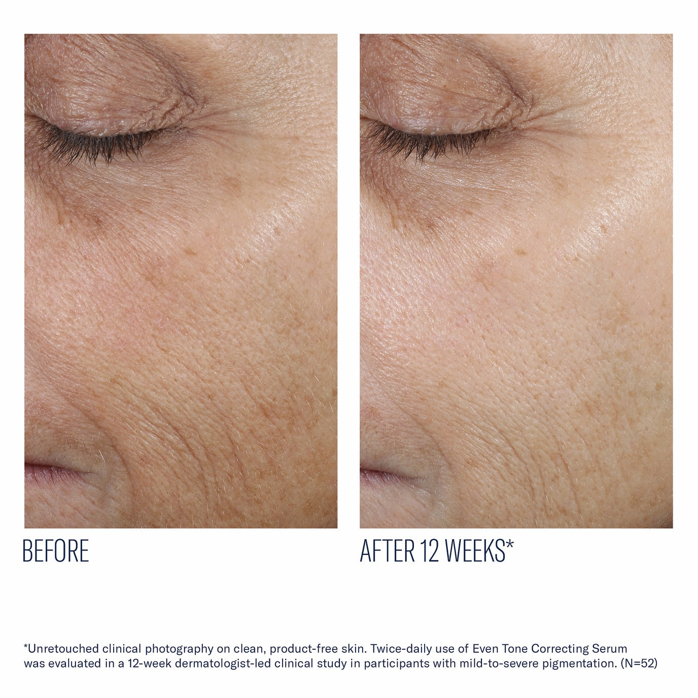 Even Skin Tone Correcting Serum - Skinbetter Science