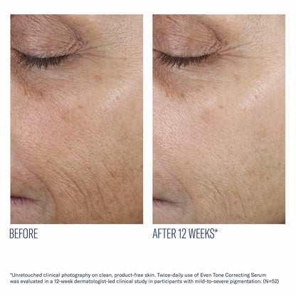 Even Skin Tone Correcting Serum - Skinbetter Science