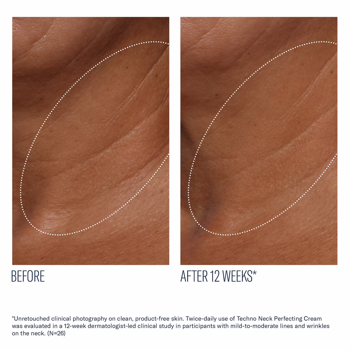 Techno Neck Perfecting Cream - Skinbetter Science